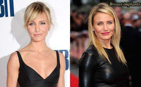 Cameron Diaz Before and After Breast Surgery