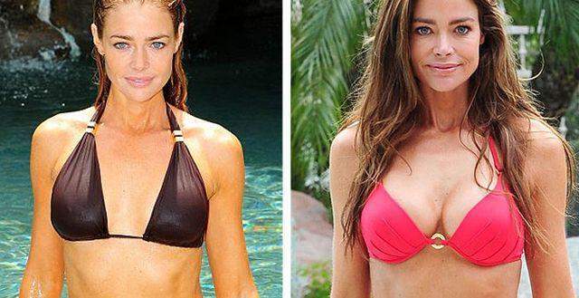 Denise Richards Before and After Boob Job