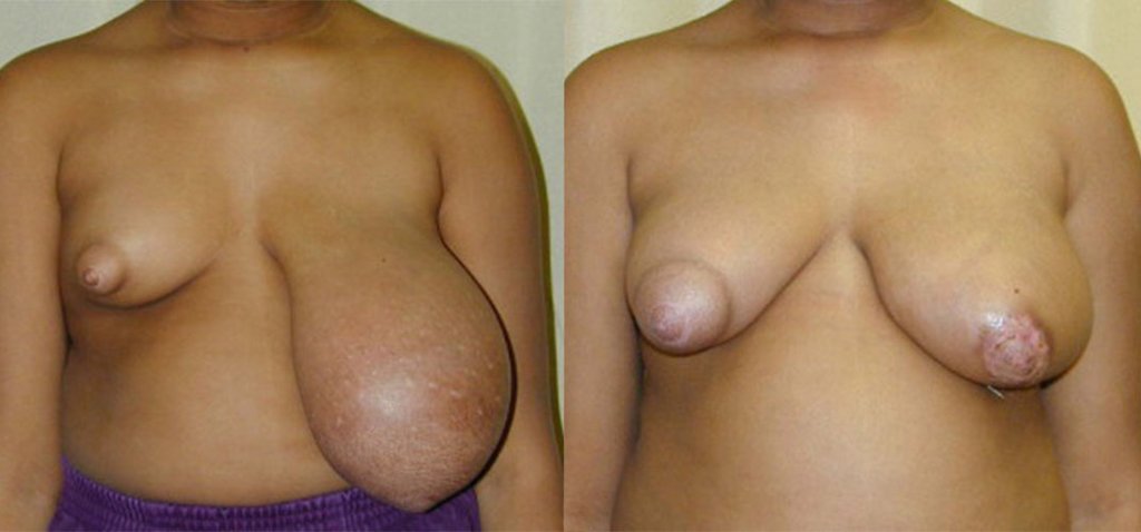example of breast hypertrophy