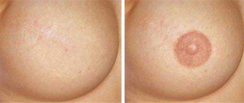 example of Areola breast pigmentation