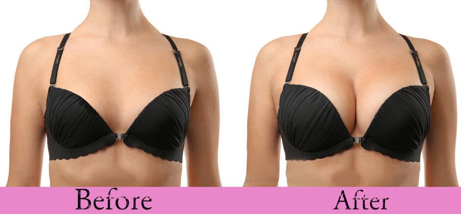 Before & After Breast Enhancement Cream