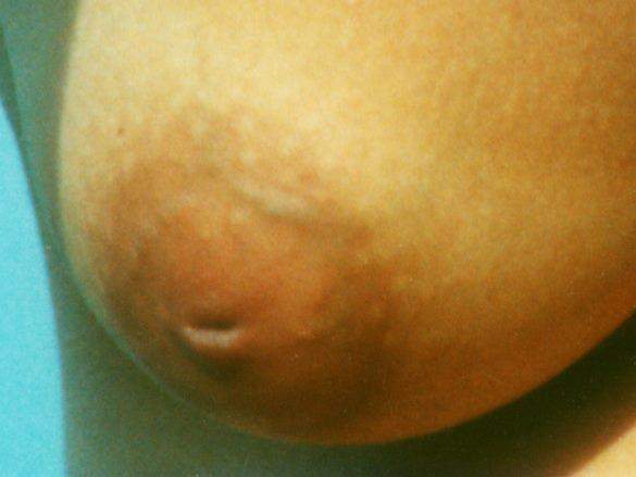 example of an inverted nipple